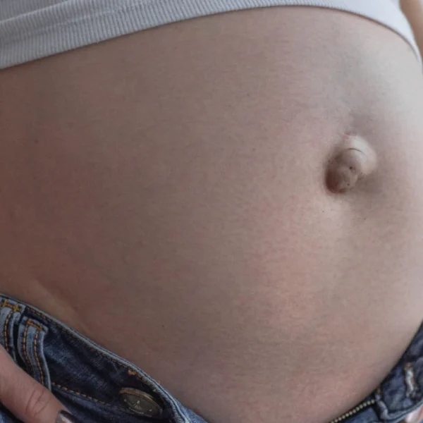 síntomas de hernia umbilical en adultos