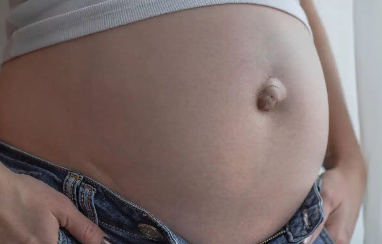 síntomas de hernia umbilical en adultos